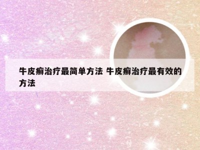 牛皮癣治疗最简单方法 牛皮癣治疗最有效的方法