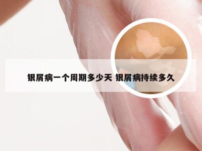 银屑病一个周期多少天 银屑病持续多久