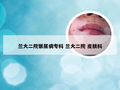 兰大二院银屑病专科 兰大二院 皮肤科