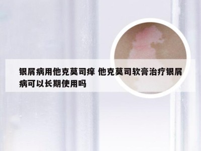 银屑病用他克莫司痒 他克莫司软膏治疗银屑病可以长期使用吗