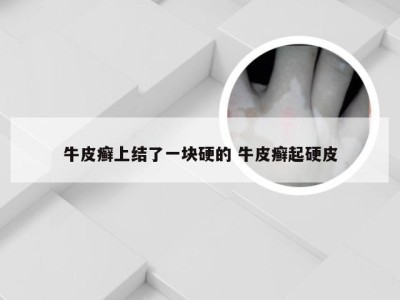 牛皮癣上结了一块硬的 牛皮癣起硬皮