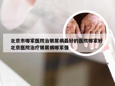 北京市哪家医院治银屑病最好的医院哪家好 北京医院治疗银屑病哪家强