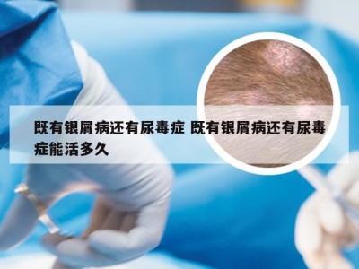 既有银屑病还有尿毒症 既有银屑病还有尿毒症能活多久