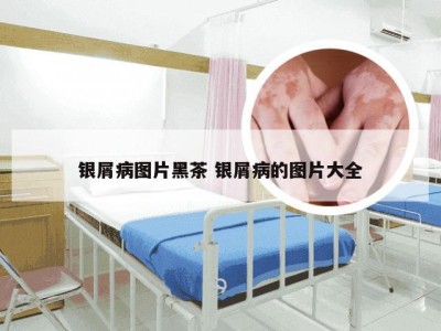 银屑病图片黑茶 银屑病的图片大全