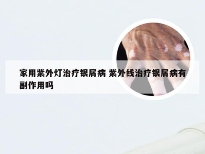 家用紫外灯治疗银屑病 紫外线治疗银屑病有副作用吗