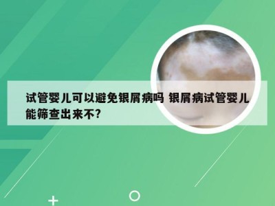 试管婴儿可以避免银屑病吗 银屑病试管婴儿能筛查出来不?