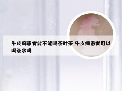 牛皮癣患者能不能喝茶叶茶 牛皮癣患者可以喝茶水吗