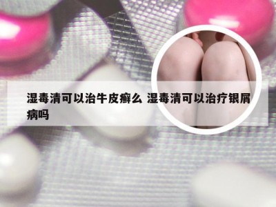 湿毒清可以治牛皮癣么 湿毒清可以治疗银屑病吗