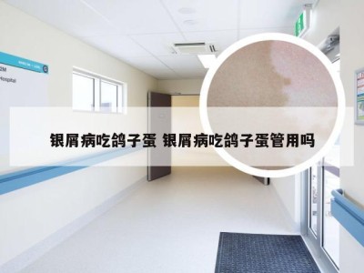银屑病吃鸽子蛋 银屑病吃鸽子蛋管用吗