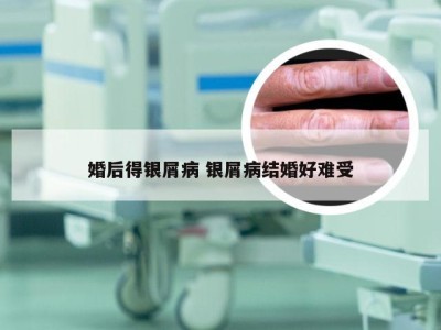婚后得银屑病 银屑病结婚好难受