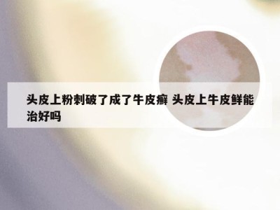 头皮上粉刺破了成了牛皮癣 头皮上牛皮鲜能治好吗