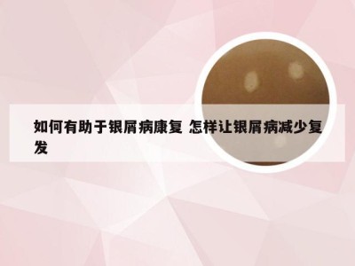 如何有助于银屑病康复 怎样让银屑病减少复发