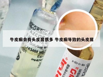 牛皮癣会有头皮屑很多 牛皮癣导致的头皮屑