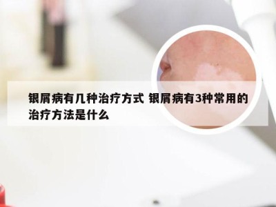 银屑病有几种治疗方式 银屑病有3种常用的治疗方法是什么
