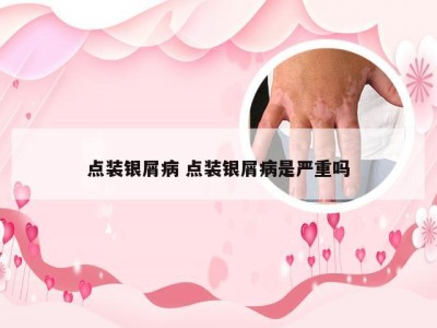 点装银屑病 点装银屑病是严重吗
