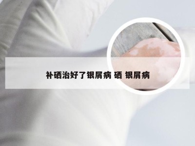 补硒治好了银屑病 硒 银屑病