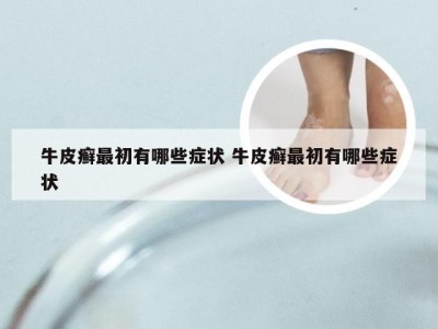 牛皮癣最初有哪些症状 牛皮癣最初有哪些症状