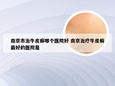 南京市治牛皮癣哪个医院好 南京治疗牛皮癣最好的医院是