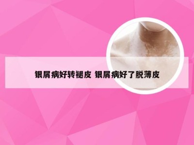 银屑病好转褪皮 银屑病好了脱薄皮