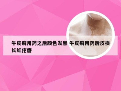 牛皮癣用药之后颜色发黑 牛皮癣用药后皮损长红疙瘩