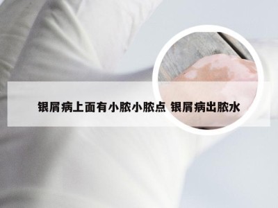 银屑病上面有小脓小脓点 银屑病出脓水