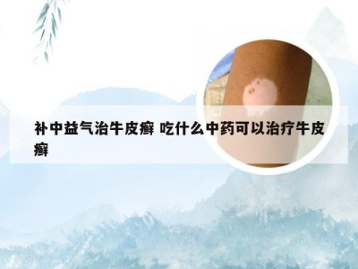 补中益气治牛皮癣 吃什么中药可以治疗牛皮癣