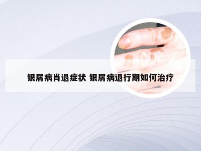 银屑病肖退症状 银屑病退行期如何治疗