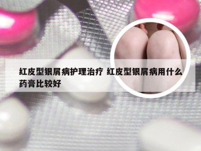 红皮型银屑病护理治疗 红皮型银屑病用什么药膏比较好
