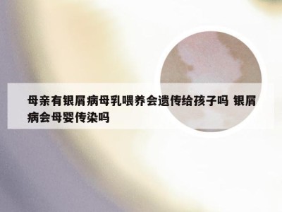 母亲有银屑病母乳喂养会遗传给孩子吗 银屑病会母婴传染吗