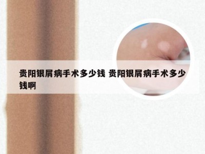 贵阳银屑病手术多少钱 贵阳银屑病手术多少钱啊