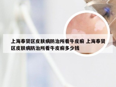 上海奉贤区皮肤病防治所看牛皮癣 上海奉贤区皮肤病防治所看牛皮癣多少钱