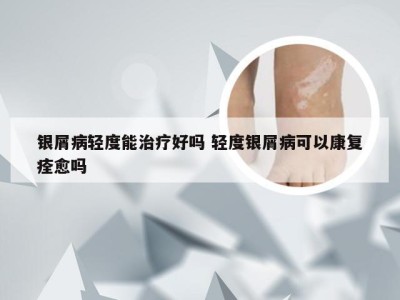 银屑病轻度能治疗好吗 轻度银屑病可以康复痊愈吗