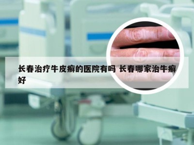 长春治疗牛皮癣的医院有吗 长春哪家治牛癣好