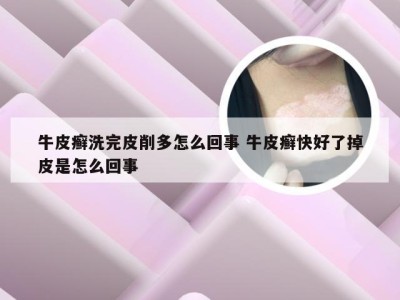牛皮癣洗完皮削多怎么回事 牛皮癣快好了掉皮是怎么回事