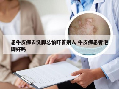 患牛皮癣去洗脚总怕吓着别人 牛皮癣患者泡脚好吗