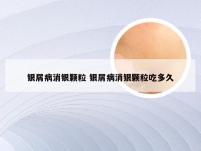 银屑病消银颗粒 银屑病消银颗粒吃多久