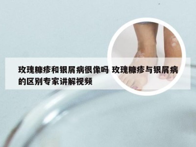 玫瑰糠疹和银屑病很像吗 玫瑰糠疹与银屑病的区别专家讲解视频