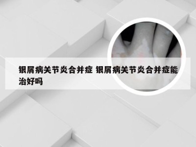 银屑病关节炎合并症 银屑病关节炎合并症能治好吗