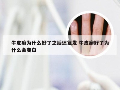 牛皮癣为什么好了之后还复发 牛皮癣好了为什么会变白
