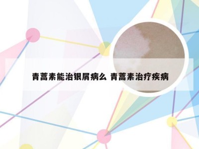 青蒿素能治银屑病么 青蒿素治疗疾病