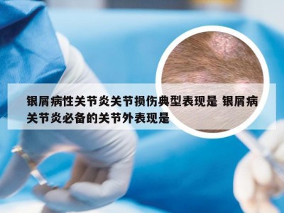银屑病性关节炎关节损伤典型表现是 银屑病关节炎必备的关节外表现是