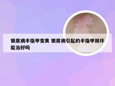 银屑病手指甲变黄 银屑病引起的手指甲损坏能治好吗