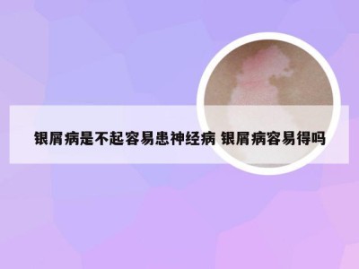银屑病是不起容易患神经病 银屑病容易得吗