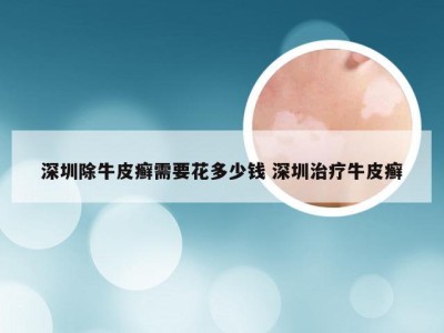 深圳除牛皮癣需要花多少钱 深圳治疗牛皮癣