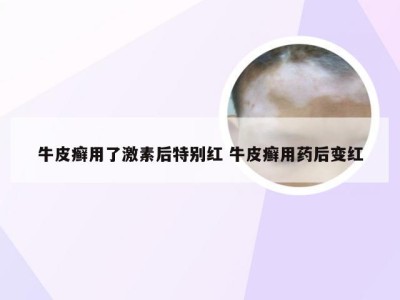 牛皮癣用了激素后特别红 牛皮癣用药后变红