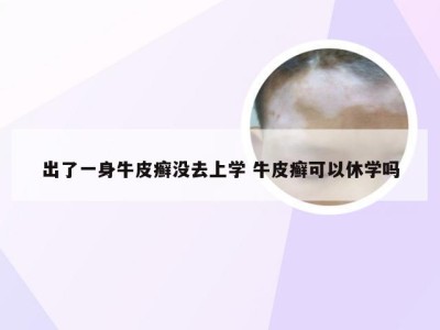 出了一身牛皮癣没去上学 牛皮癣可以休学吗