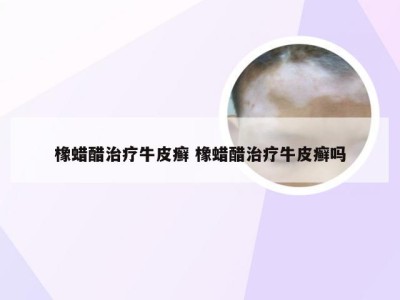 橡蜡醋治疗牛皮癣 橡蜡醋治疗牛皮癣吗