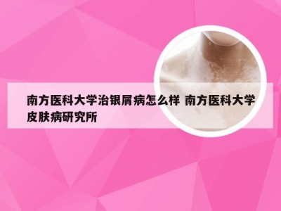 南方医科大学治银屑病怎么样 南方医科大学皮肤病研究所