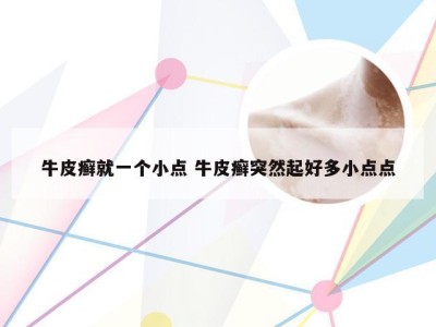 牛皮癣就一个小点 牛皮癣突然起好多小点点