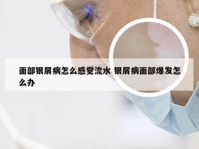面部银屑病怎么感觉流水 银屑病面部爆发怎么办